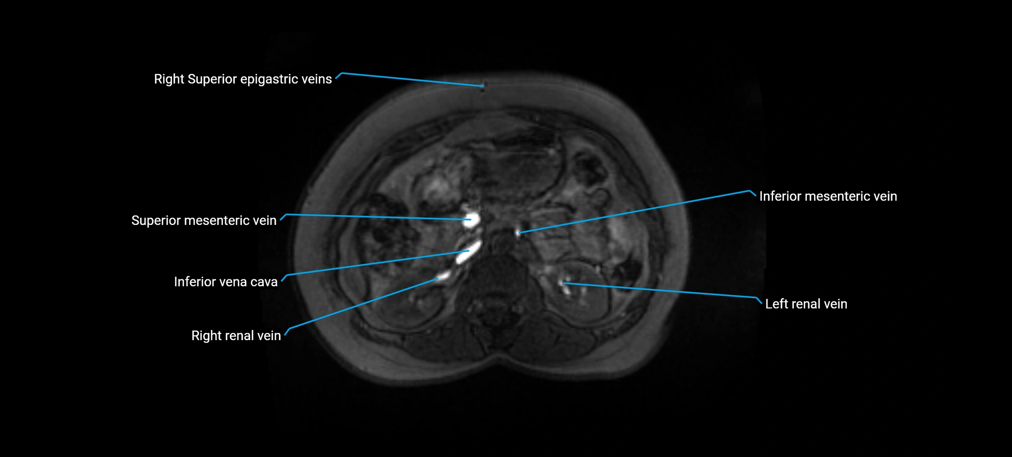MRV abdomen pelvis & lower limb axial cross sectional anatomy labelled MRI image 68 (1).webp
